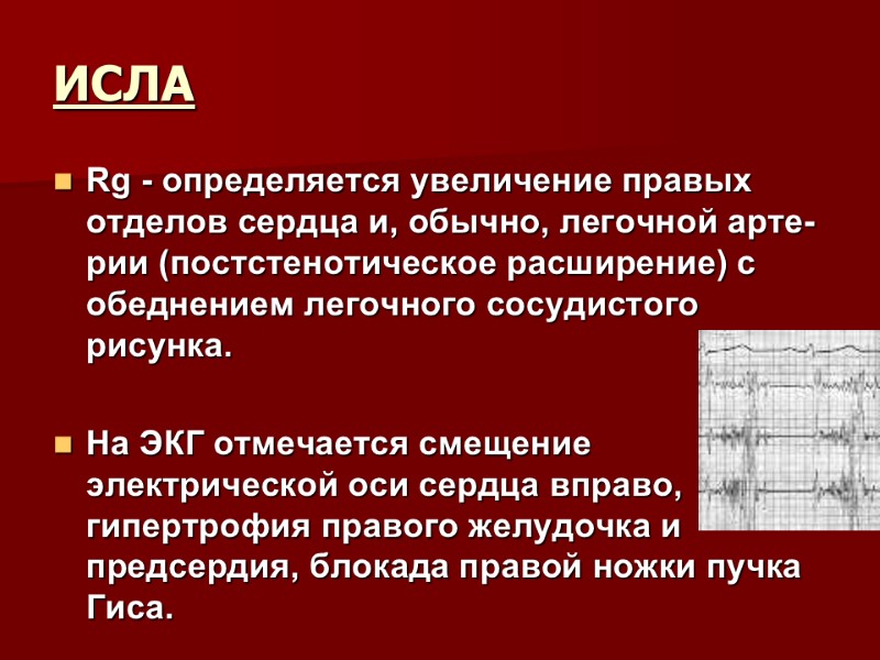 ИСЛА  Rg - определяется увеличение правых отделов сердца и, обычно, легочной арте­рии (постстенотическое